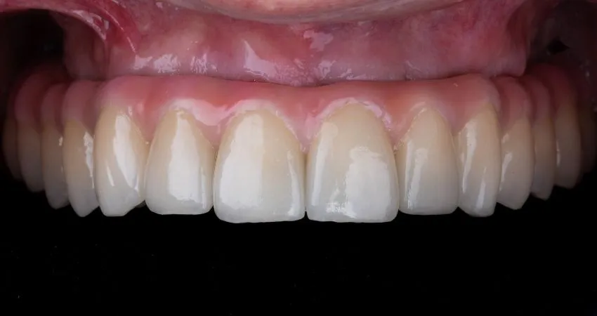 Tam ağız diş implantı tedavisi nasıl yapılır? - Antalya Tam ağız diş implantı tedavisi nasıl yapılır?Antalya