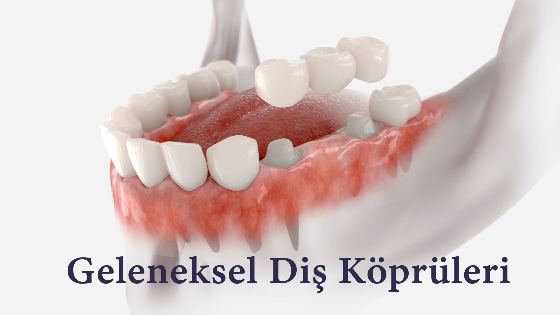 Konvansiyonel Sabit Köprüler (Geleneksel Diş Köprüleri) Konvansiyonel Sabit Köprüler (Geleneksel Diş Köprüleri) Antalya