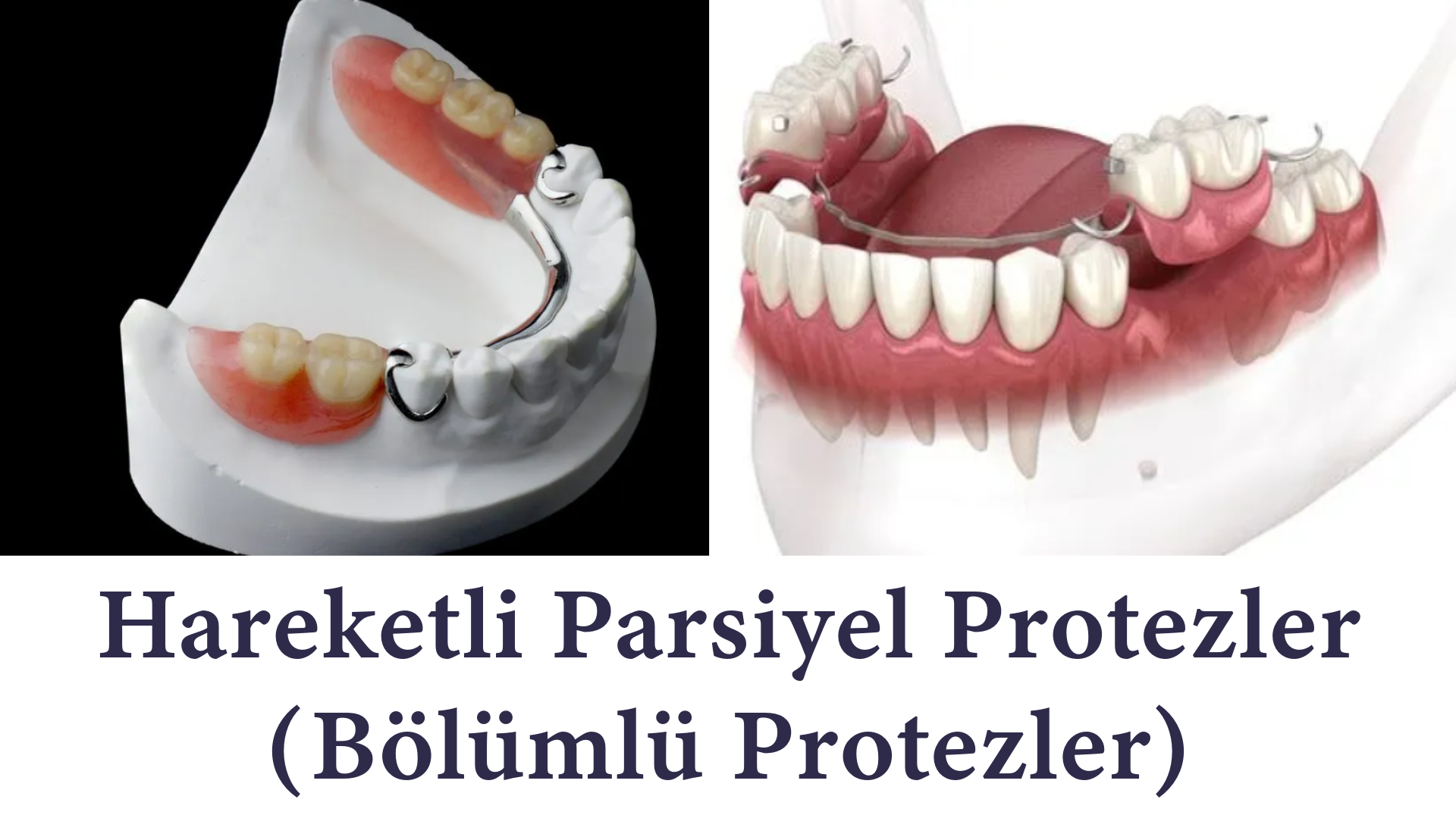 İmplant Yerine Hareketli Parsiyel Protezler (Bölümlü Protezler) - Antalya İmplant Yerine Hareketli Parsiyel Protezler (Bölümlü Protezler) Antalya