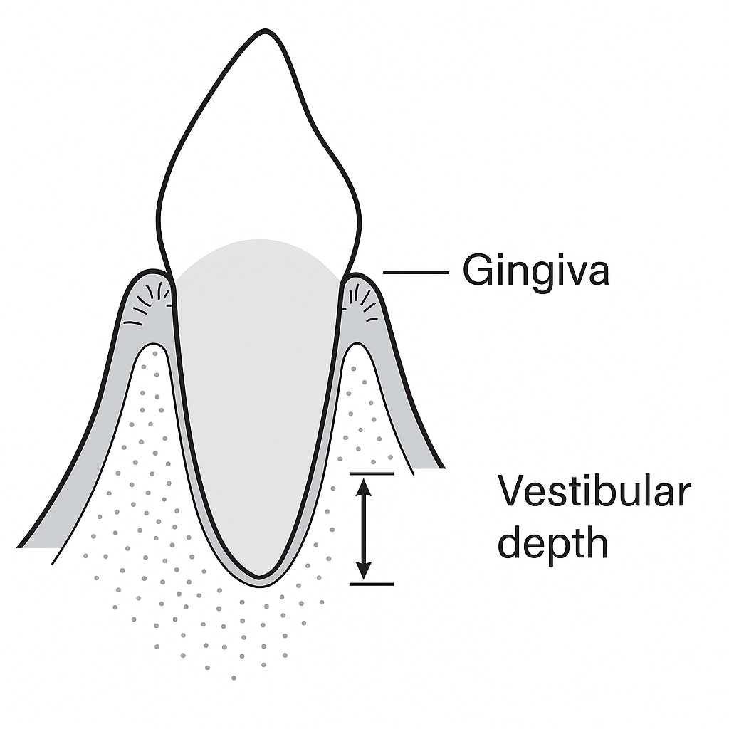 Vestibular groove depth