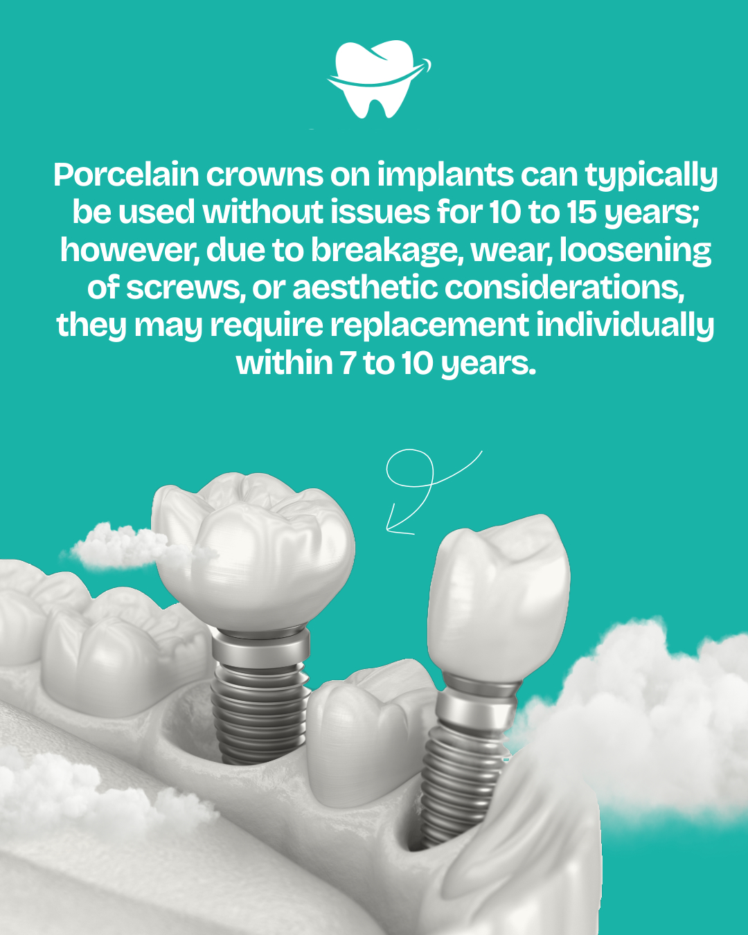 How Long Do Dental Crowns Last?