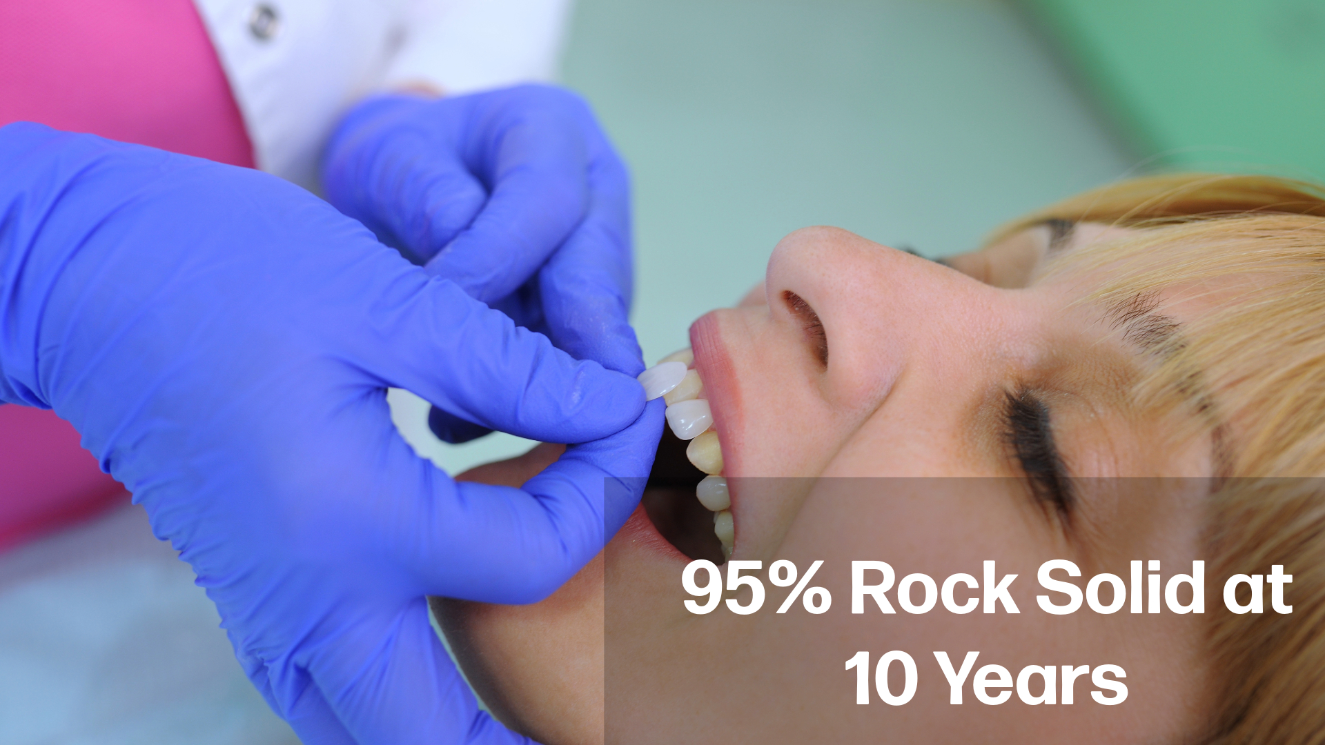 Lifespan of Porcelain Lamina Veneers