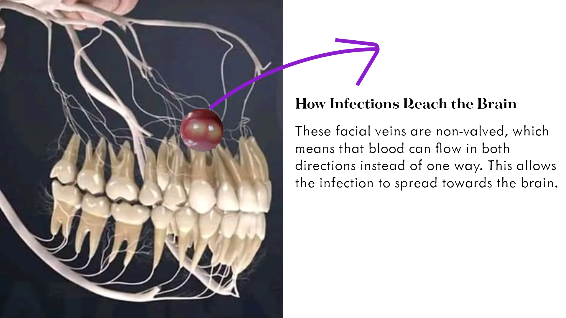 Infections that spread to the brain: How does it happen? Infections that spread to the brain: How does it happen?
