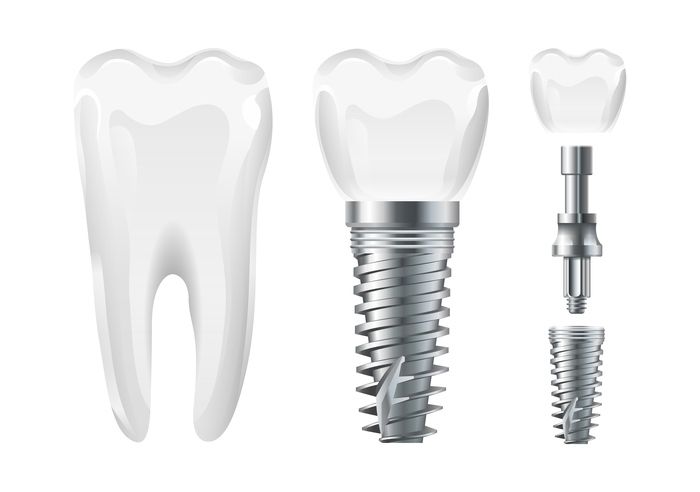 Как выбрать зубные импланты и наиболее надежные производители