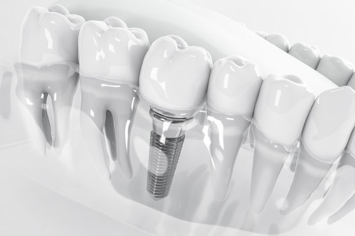 implant teeth on a jawbone model