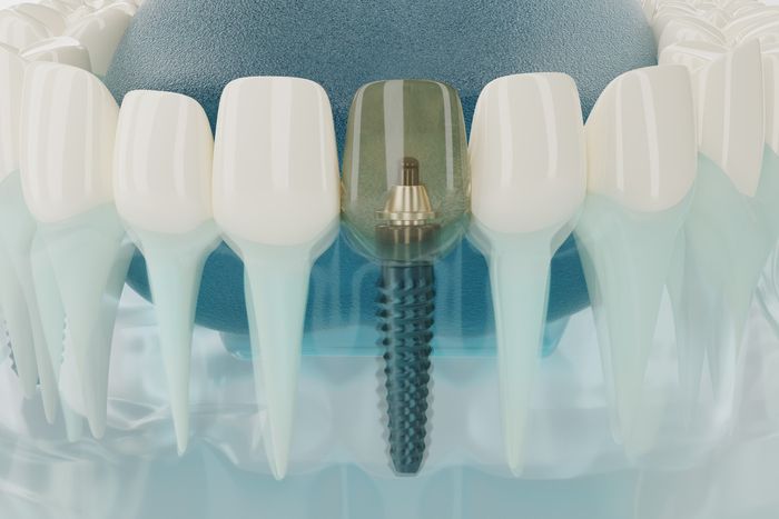best dental implants companies