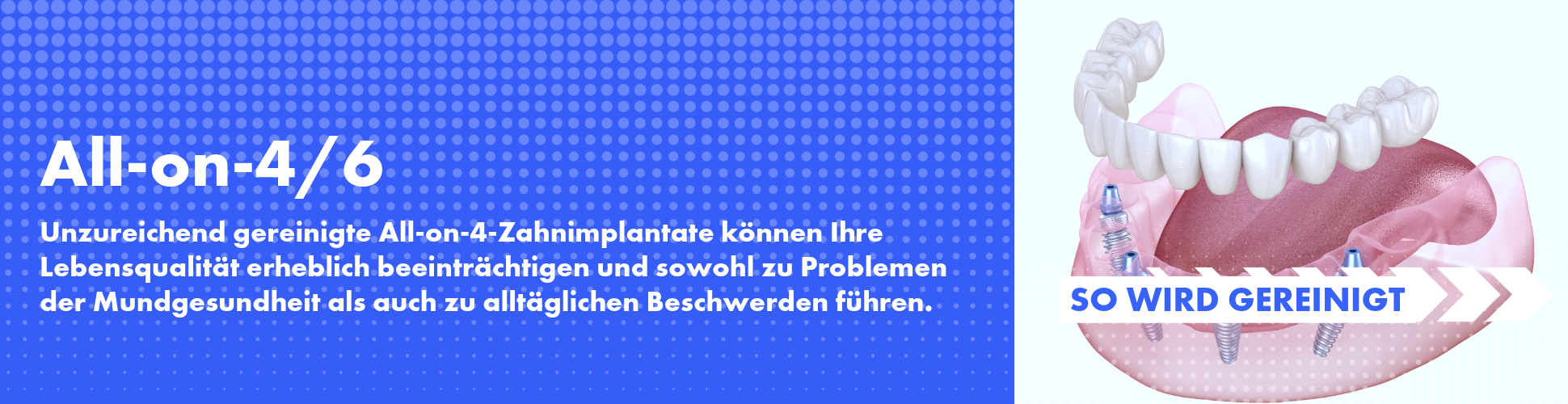 So reinigen Sie All-on-4- und All-on-6-Zahnimplantate So reinigen Sie All-on-4- und All-on-6-Zahnimplantate