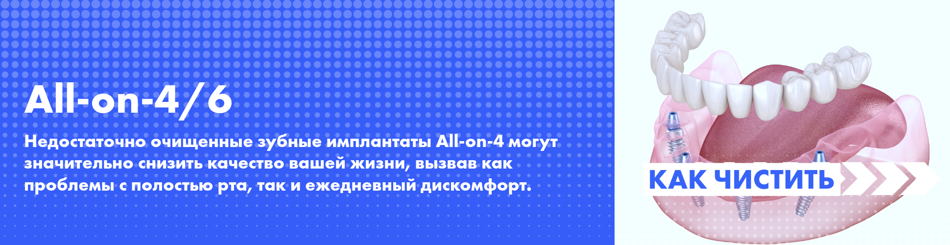 Как чистить зубные имплантаты All-on-4 и All-on-6 
