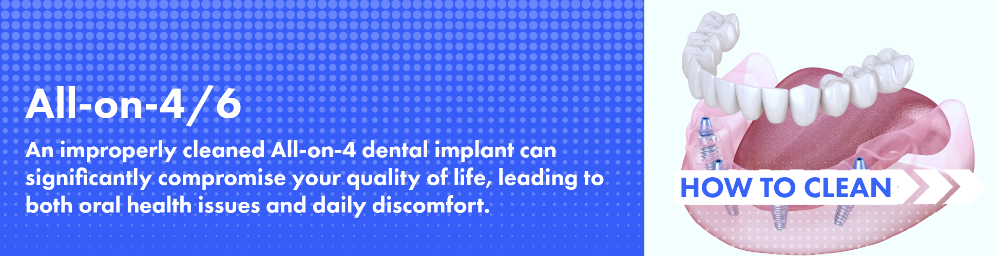 How to Clean All-on-4 and All-on-6 Dental Implants