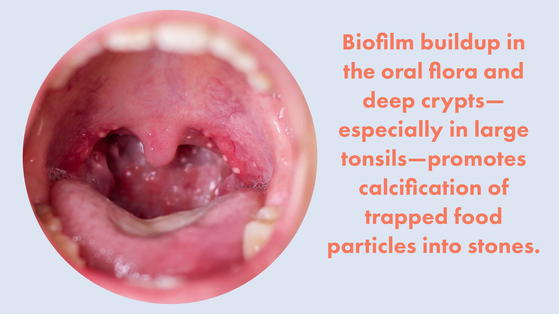 Why do tonsil stones develop?