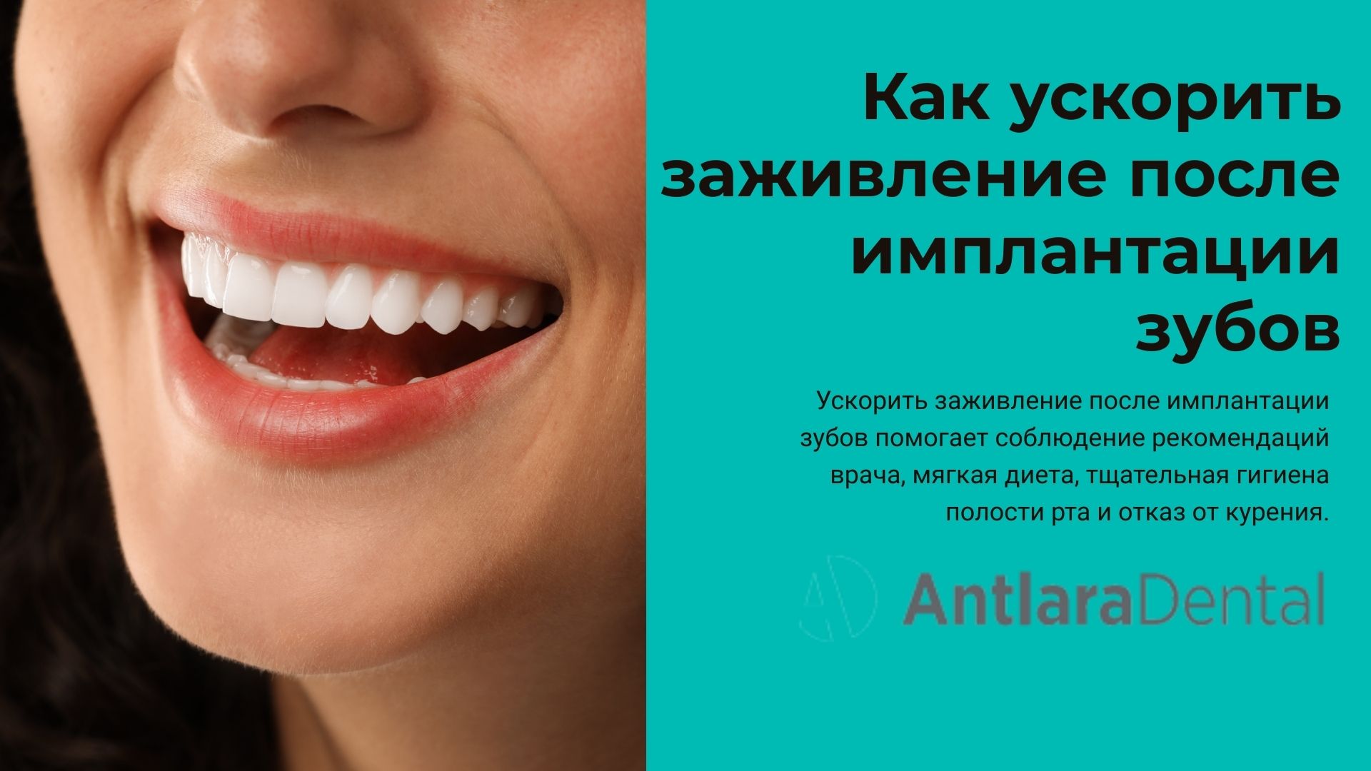  Как ускорить заживление после имплантации зубов 