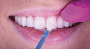 Fluoride varnishes and gels Fluoride varnishes and gels