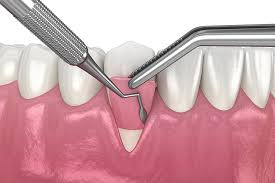 Gum Graft (Soft Tissue Graft) Gum Graft (Soft Tissue Graft)