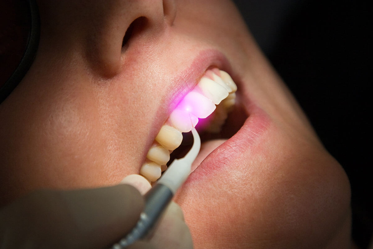 Laser Treatment Laser Treatment