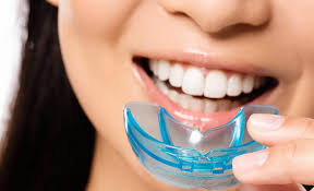 Mouth Guard (Night Guard) Mouth Guard (Night Guard)
