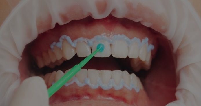 Hydrogen Peroxide for Teeth Whitening