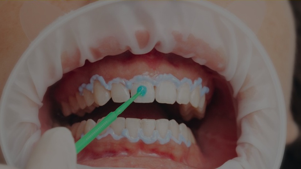 Hydrogen Peroxide for Teeth Whitening Hydrogen Peroxide for Teeth Whitening