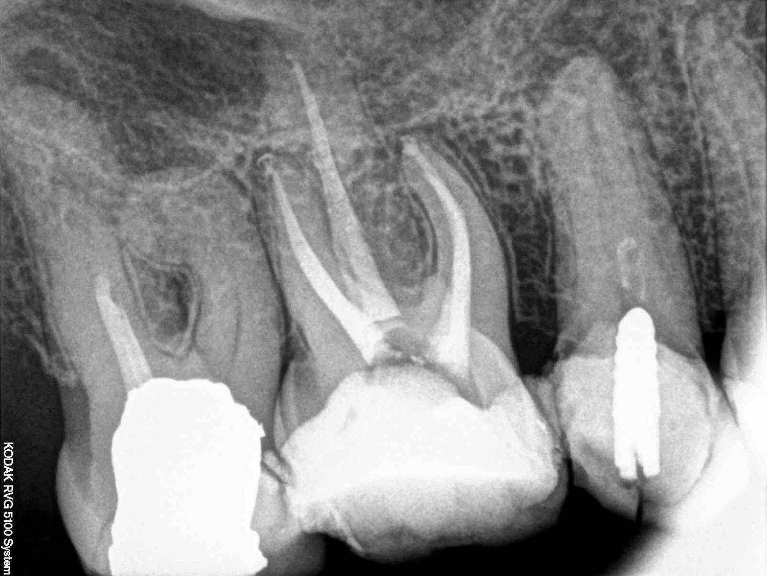 Multi-rooted teeth challenges Multi-rooted teeth challenges