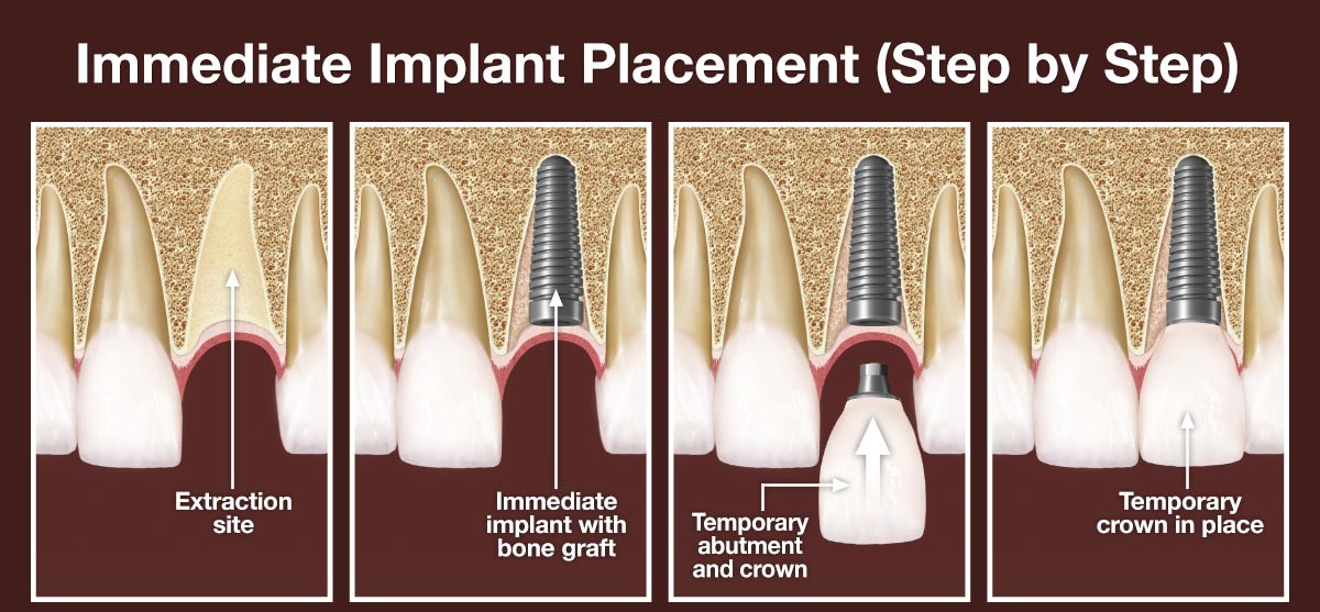 Immediate Implant Placement After Tooth Extraction Immediate Implant Placement After Tooth Extraction
