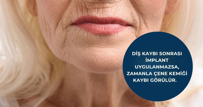 Çene kemiği erimesi olanlara implant diş tedavisi uygulanabilir. Çene kemiği erimesi olanlara implant diş tedavisi uygulanabilir.