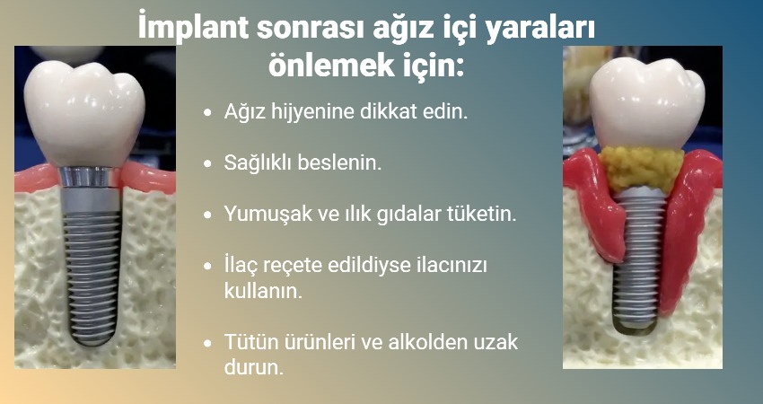 İmplant sonrası ağız içi yaraların çabuk iyileşmesi için ne yapılabilir? Antalya İmplant sonrası ağız içi yaraların çabuk iyileşmesi için ne yapılabilir? Antalya