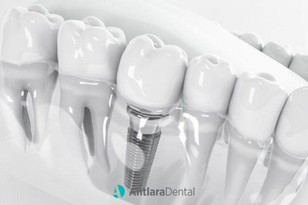 Antalya Diş implantı tedavisi sonrası yapılması gerekenler
