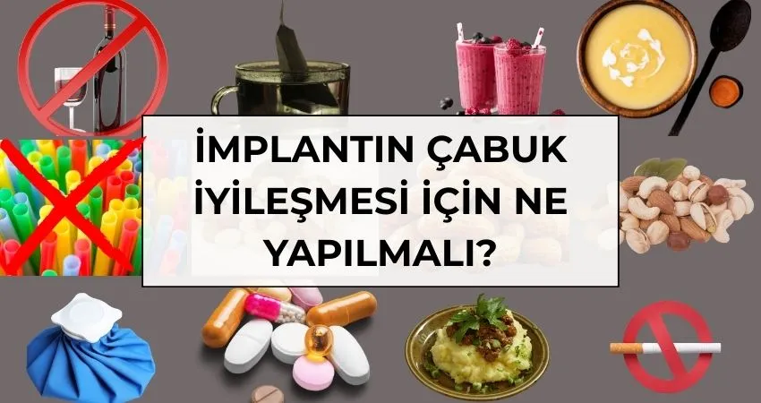 İmplantın Çabuk İyileşmesi için Nelere Dikkat Edilmeli? - Antalya İmplantın Çabuk İyileşmesi için Nelere Dikkat Edilmeli? | Antalya