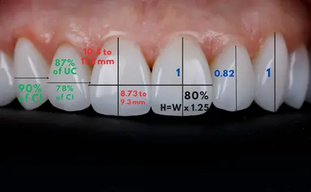 Incisal lengths in smile design