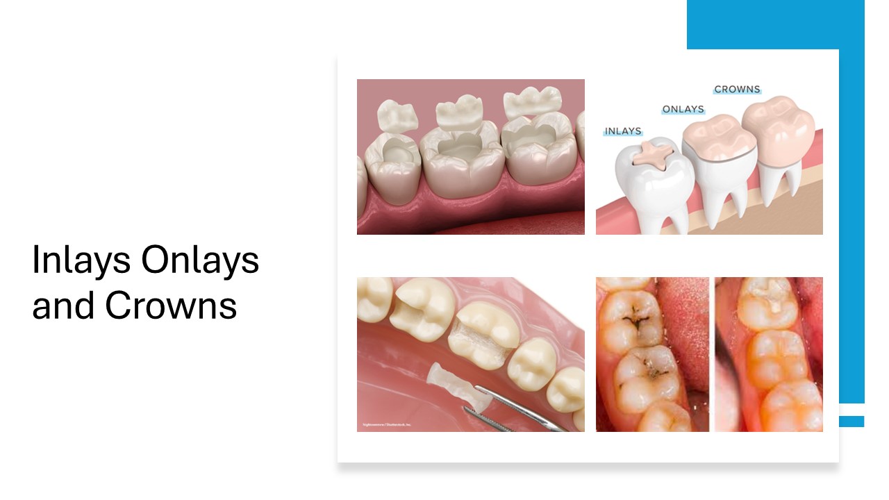 Inlay Onlay Or Crown Which Treatment Is Right For You Inlay Onlay Or Crown Which Treatment Is Right For You