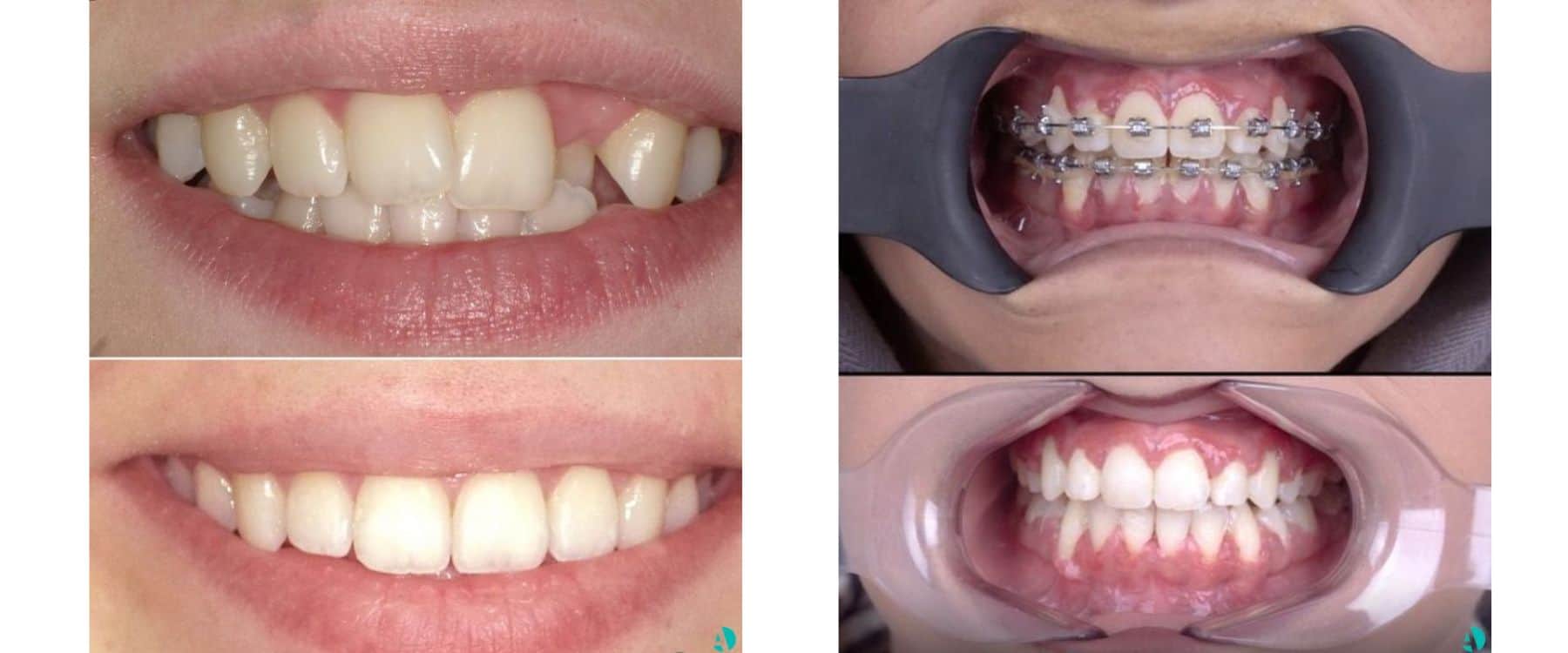 Invisalign vs braces before after