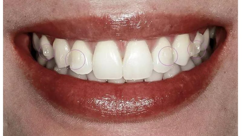 invisaling attachment shows on teeth