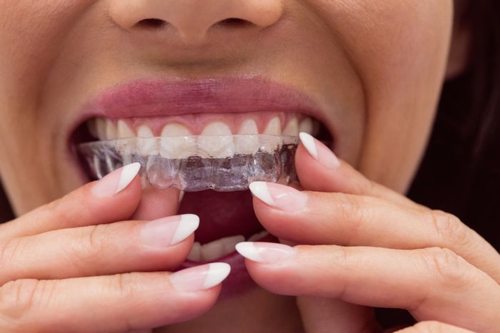 women wears invisalign 