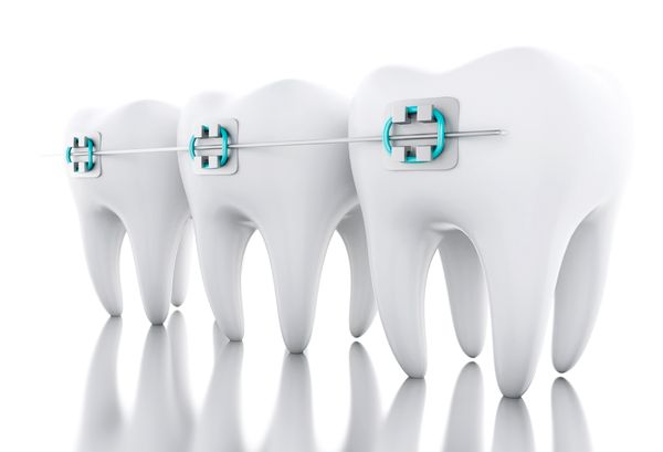 Metal braces on teeth