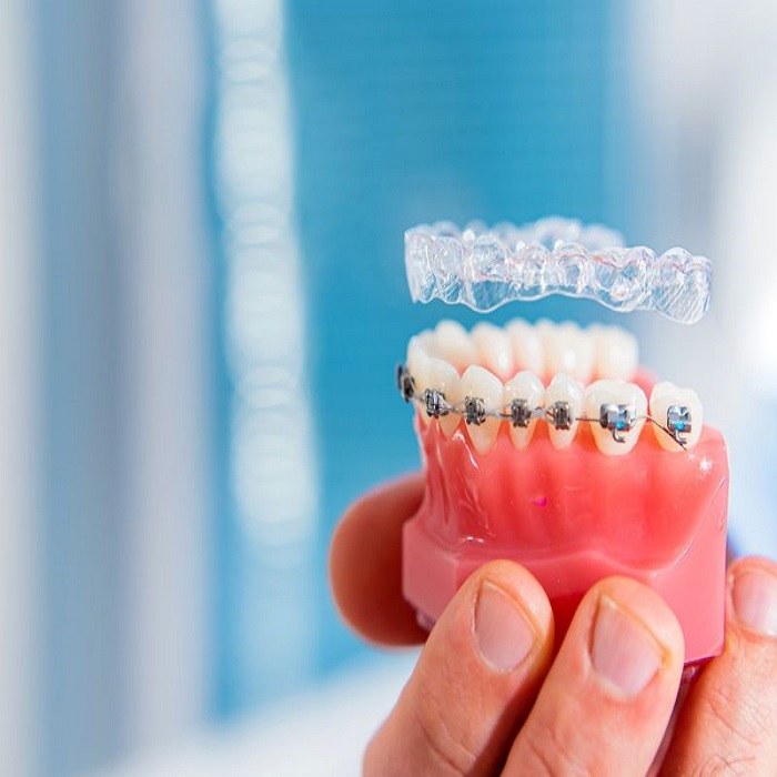 Invisalign vs. Braces: A Complete Guide