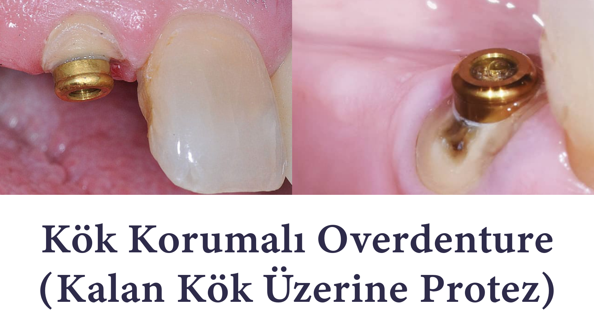 Kök Korumalı Overdenture Protezler (Kalan Kök Üzerine Protez) Kök Korumalı Overdenture Protezler (Kalan Kök Üzerine Protez)Antalya
