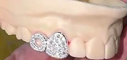 Bei Diamond Grillz handelt es sich nicht um eine medizinische Behandlung.