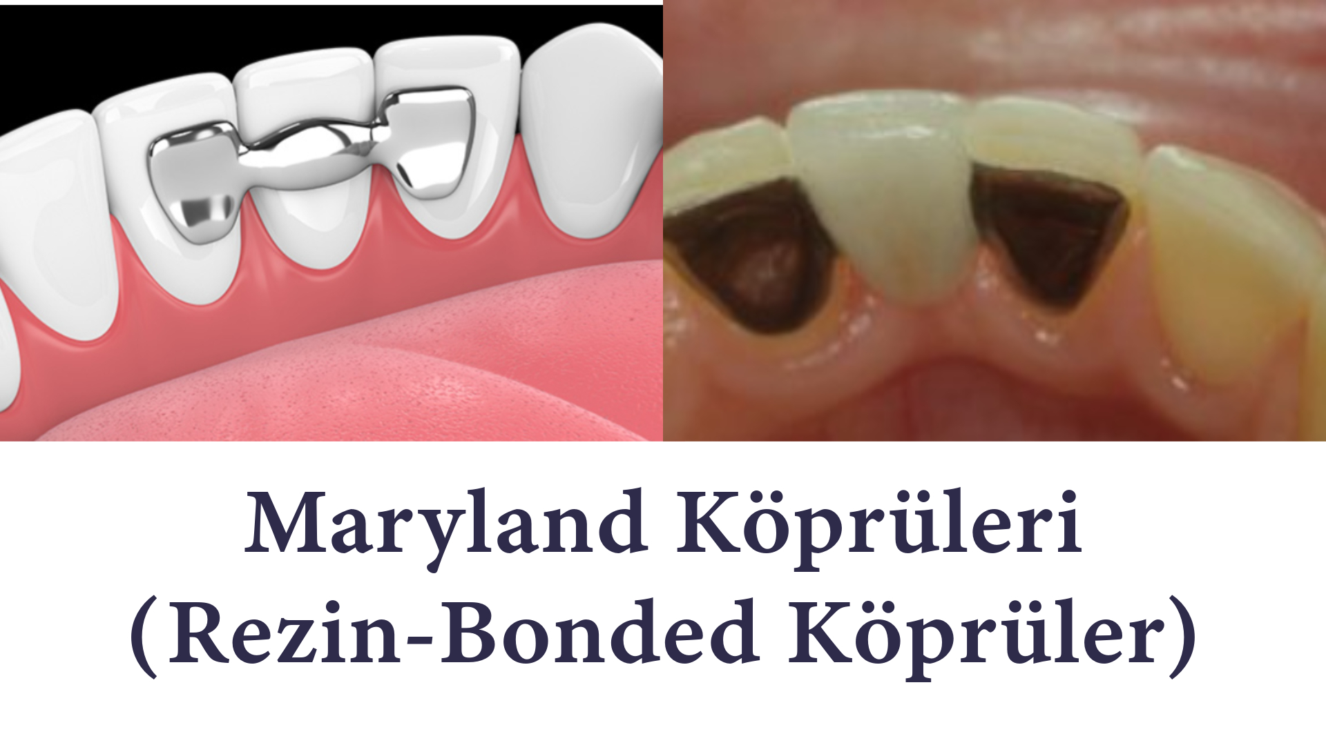 İmplant yerine maryland köprüleri (Rezin-bonded köprüler) İmplant yerine maryland köprüleri (Rezin-bonded köprüler) Antalya