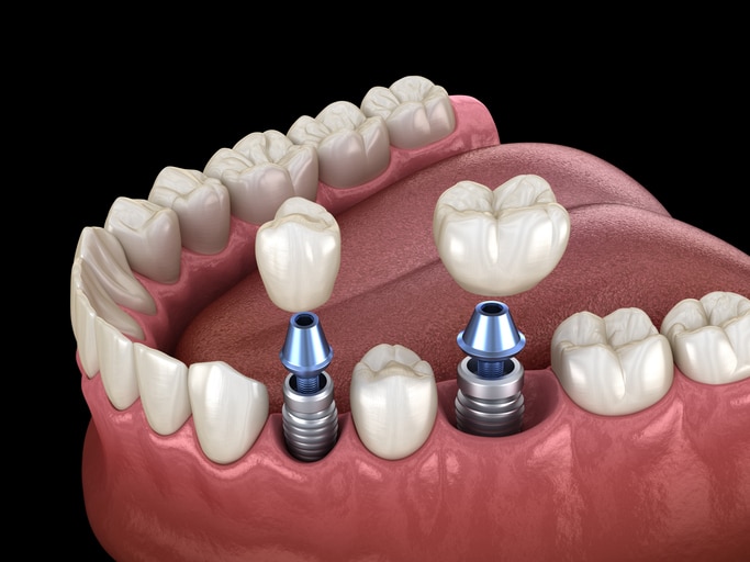 Обычные зубные имплантаты