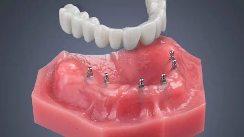 Мини-имплантаты для зубных протезов