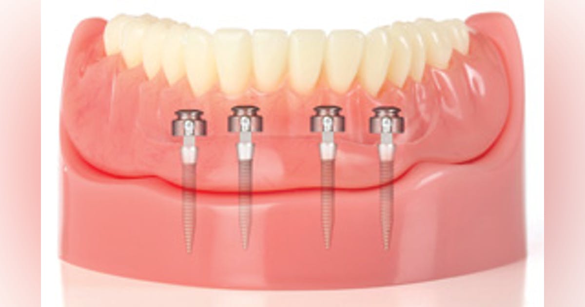 Mini Dental Implants