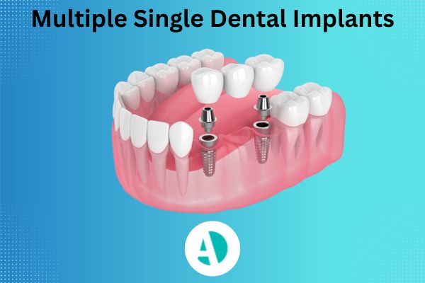 Multiple tooth implant Antalya