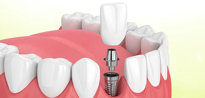 Crown with implant support