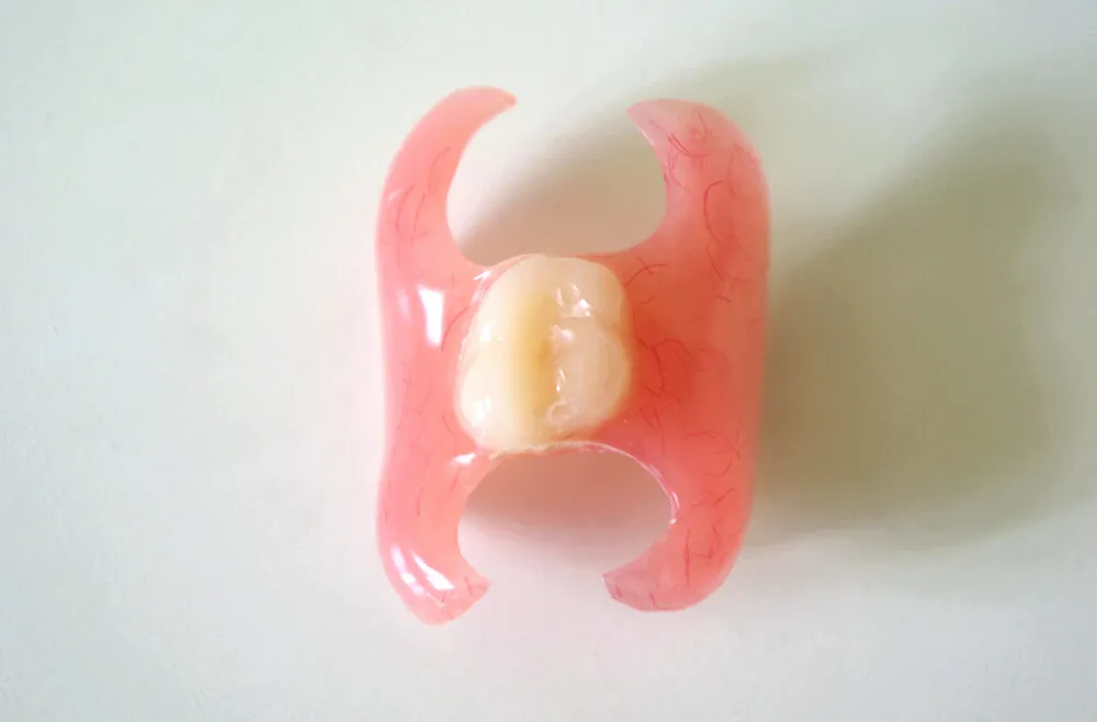 Acrylic (temporary) partial denture (flipper)