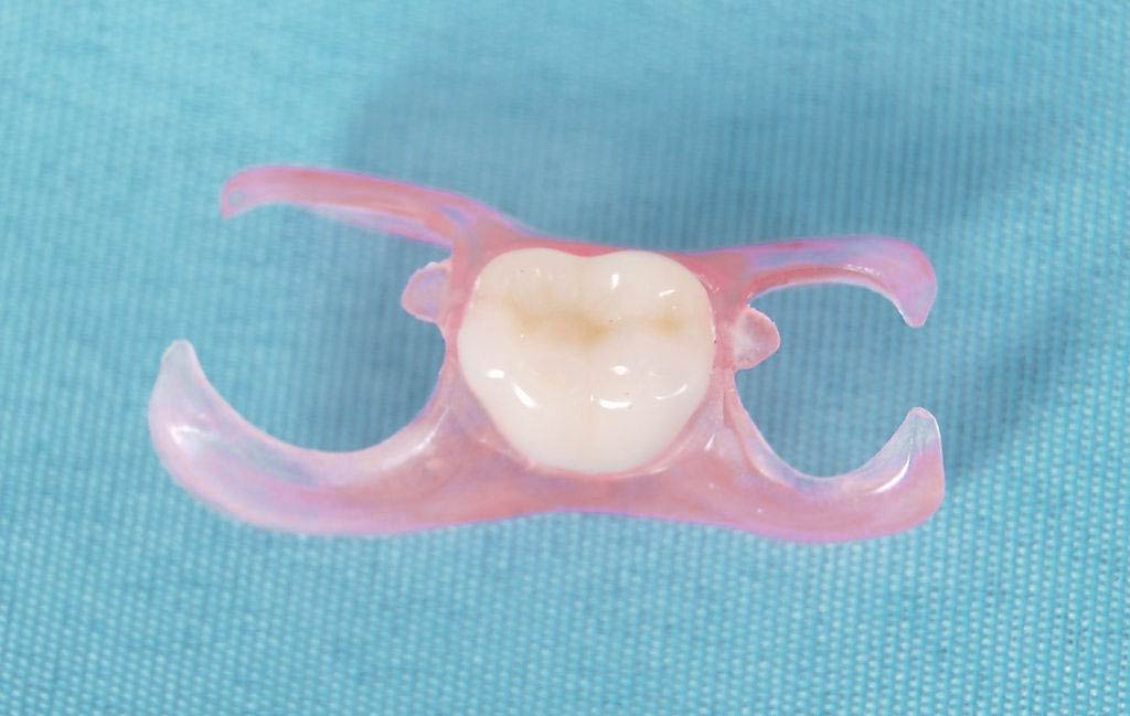 How does a single tooth denture stay in?