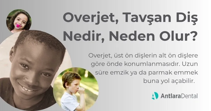 Overjet Nedir? - Tavşan Diş Tedavisi - Antalya