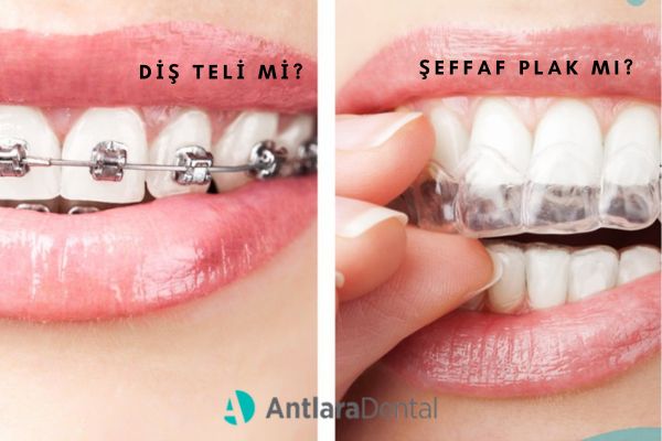 Antalya Diş Çapraşıklığını Düzeltirken Diş Teli mi Şeffaf Plak mı? Hangisi İyi