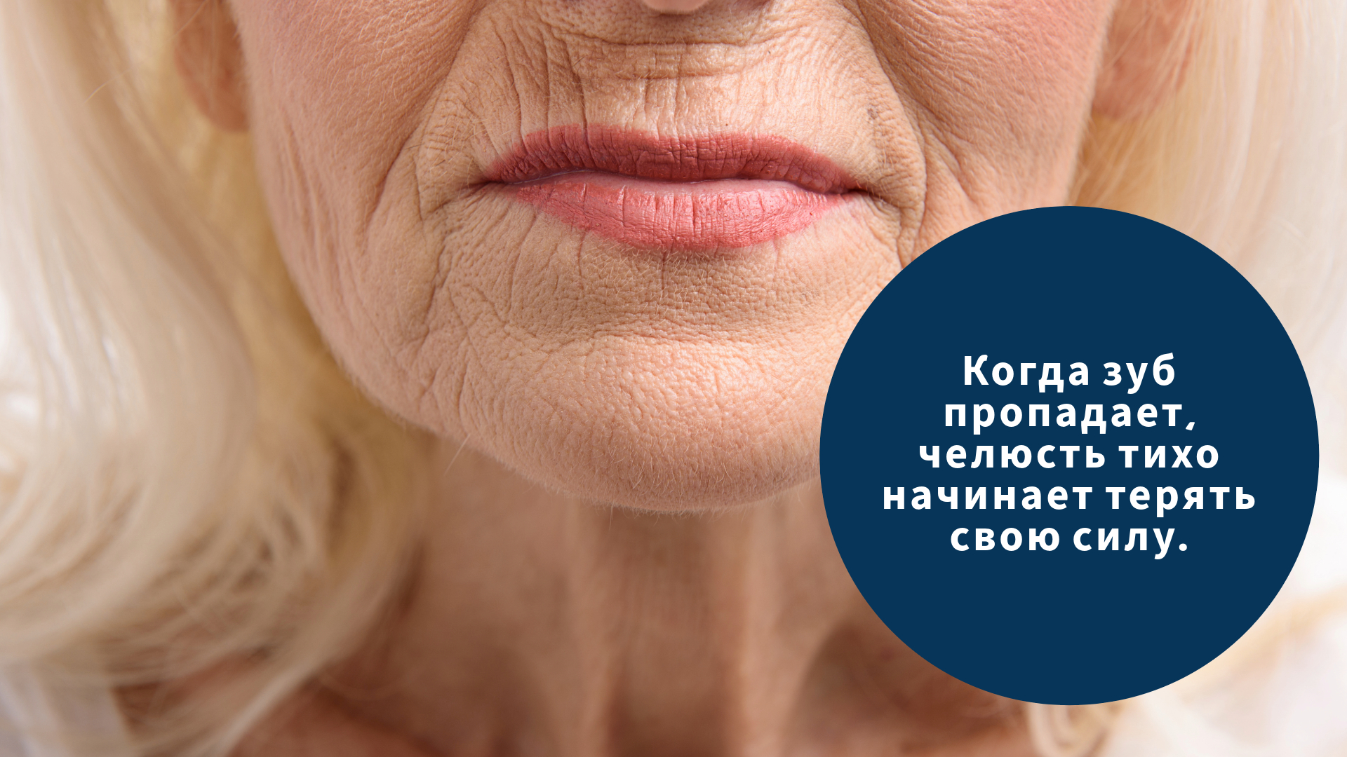 Резорбция челюстной кости 