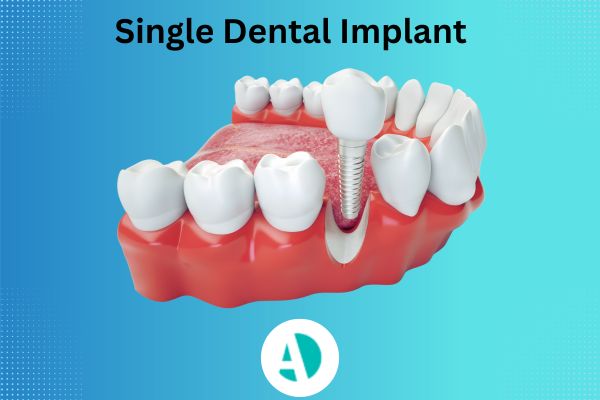 Single tooth implant Antalya