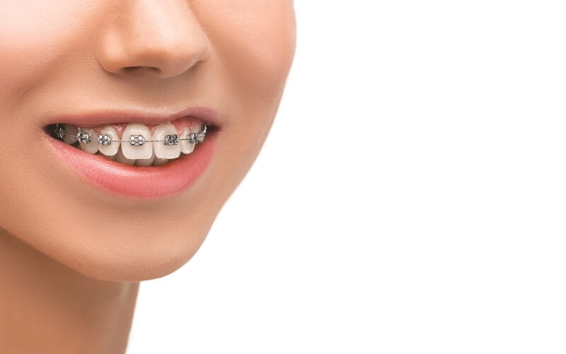 Why bother with orthodontic treatment if veneers are so accessible?