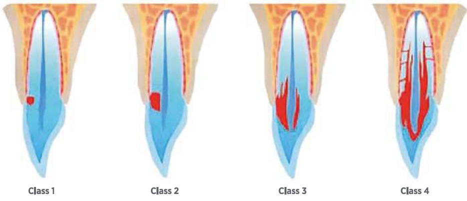 All part of the external resorption category